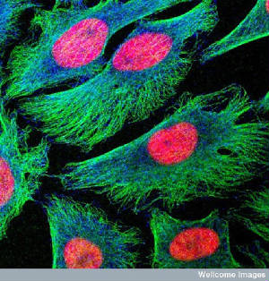 Human cancer cells in culture