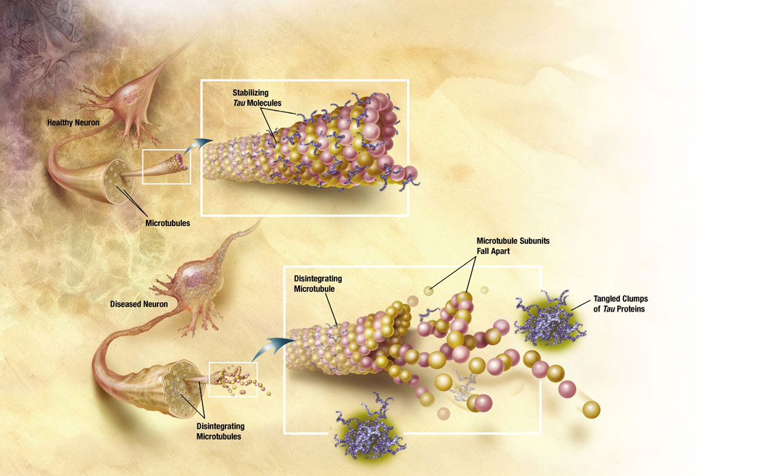 Imagen comparativa de la desintegracion de neurona